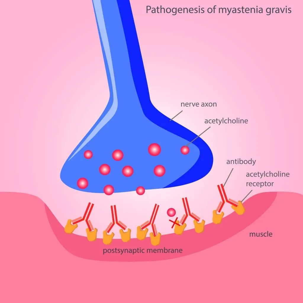 Myasthenia Gravis