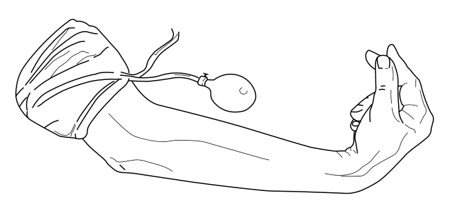 Trousseau's sign